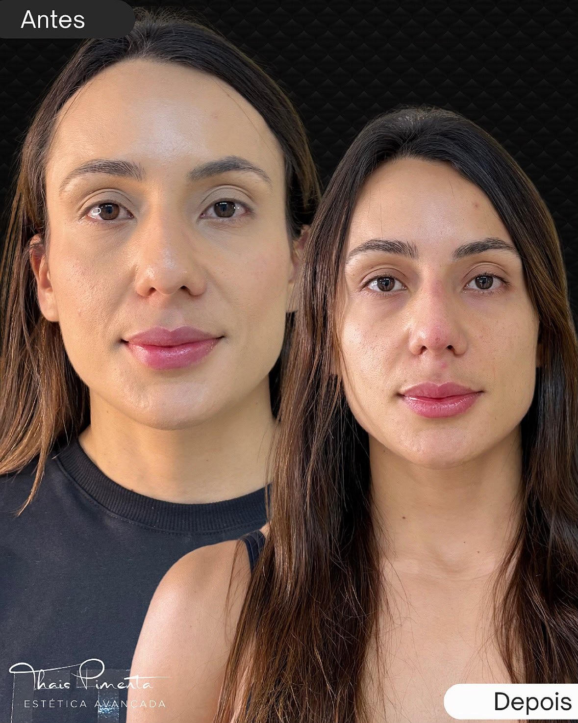Harmonização Facial - Antes e Depois